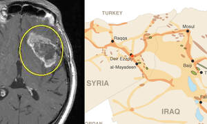 ISIS and brain tumors look similar and share many characteristics