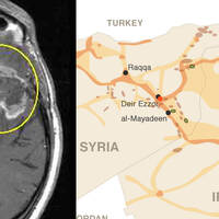 ISIS and brain tumors look similar and share many characteristics